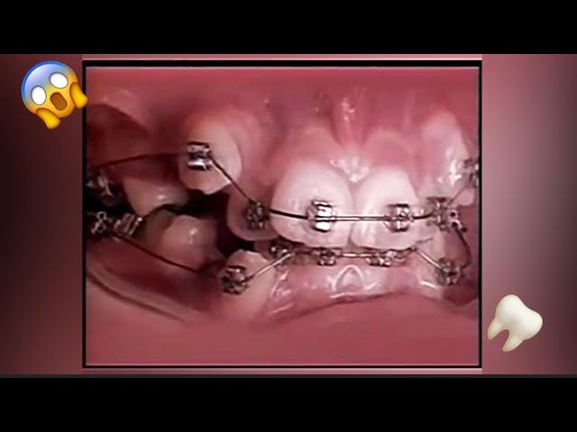 2 Years Of Braces In 20 Seconds!- Braces Timelapse #Shorts