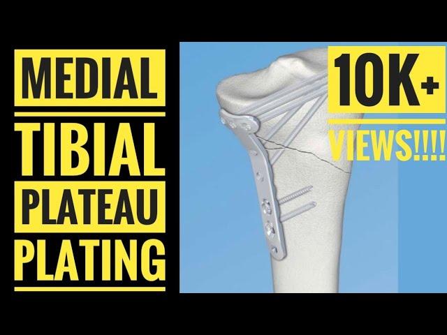 Medial Approach and Plating of Medial Tibial Condyle