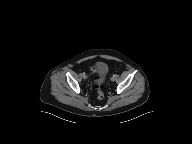 Gastric ulcer