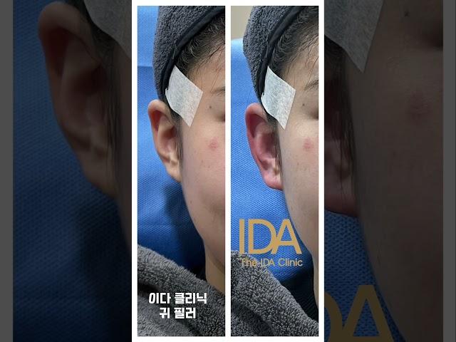 연예인들이 좋아하시는 필러가 어느 부위 필러인지 아시나요?