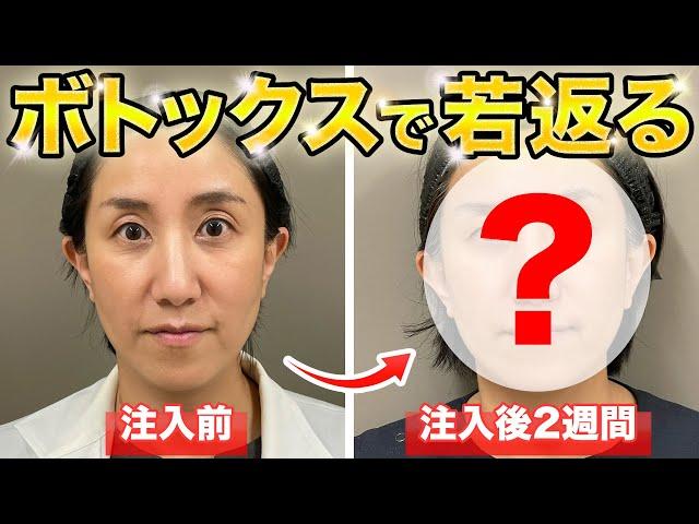 ボトックス治療での若返りの様子を大公開！【美容医療】