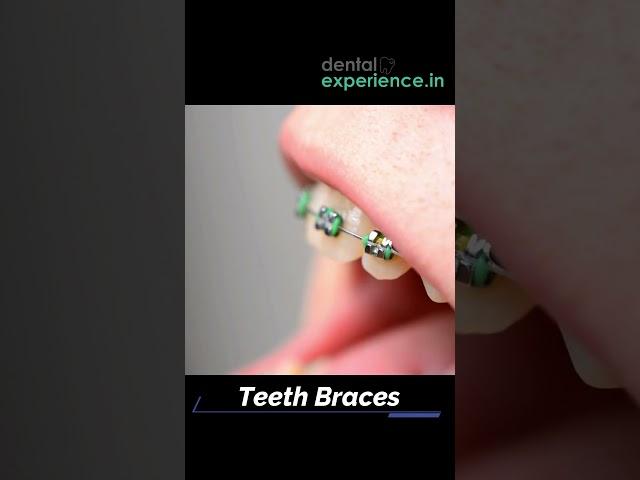 Affordable | Metal braces | Ceramic Teeth Braces | Clear Teeth Aligners Cost in Kochi, Kerala, India