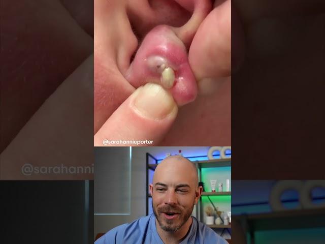 Doctor reacts to foul infected piercing pop! #earpiercing #pimplepop #infection