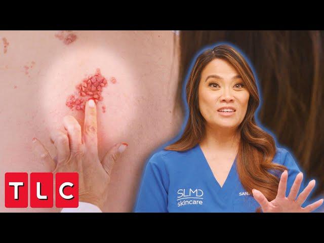 Oddly Satisfying Back Bumps? Dr. Lee Adores This Strange Patch of Bumps | Dr. Pimple Popper