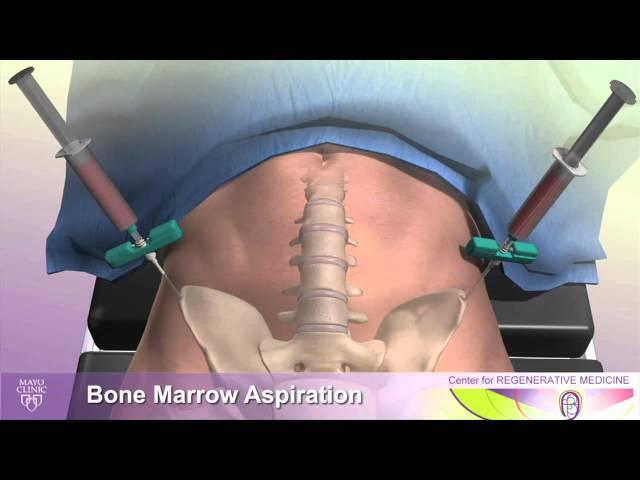 Avascular Necrosis and Minimally Invasive Treatment Using Stem Cells - Mayo Clinic