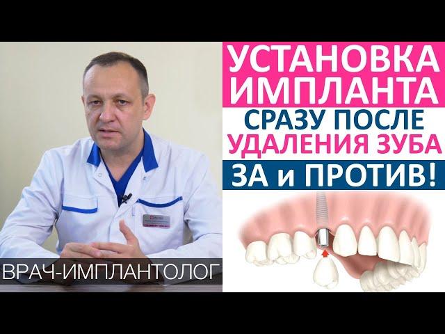 Установка зубного импланта сразу после удаления зуба. За и против! Одномоментная имплантация зубов.