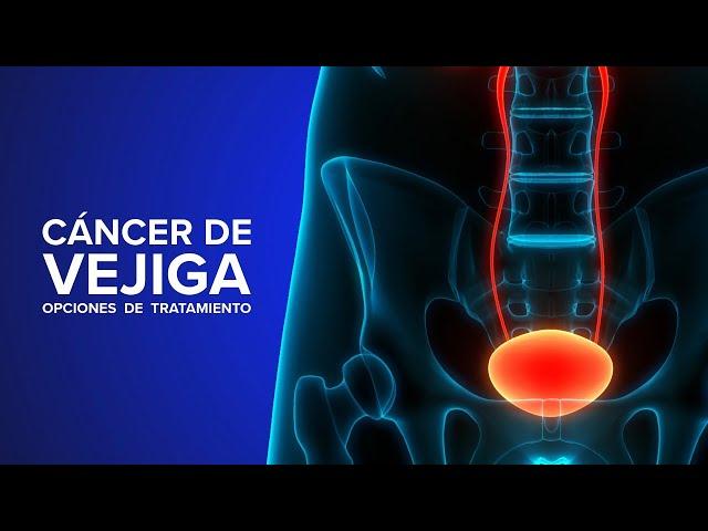 Cáncer de Vejiga - Una experta explica opciones de tratamiento