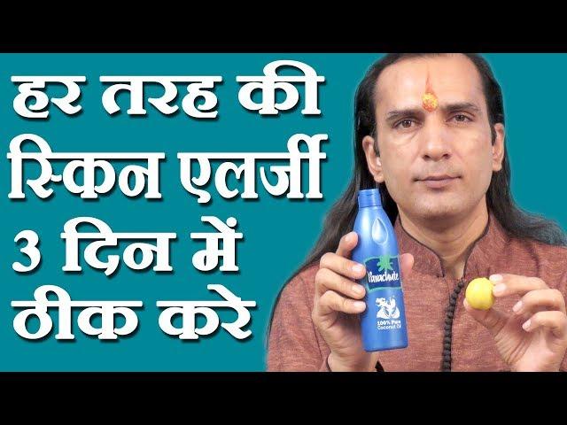 स्किन एलर्जी का घरेलू नुस्खा How To Cure Skin Allergy - skin allergy treatment at home -Sachin Goyal