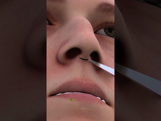 Ever Wonder How Rhinoplasty Surgery Works!|Nose job done