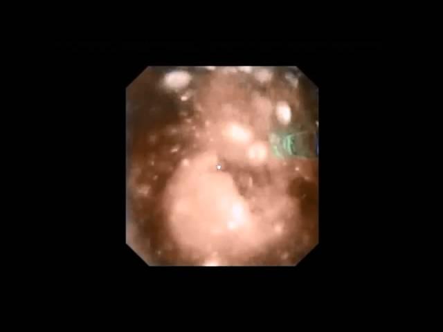 Kidney Stone Treatment by RIRS with flexible ureterorenoscope