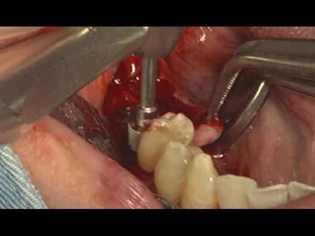 Immediate implantation using Dentium SuperLine system on post. mandible (Live)