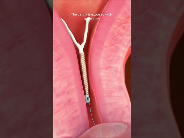 IUD Removal #shortvideo #viral