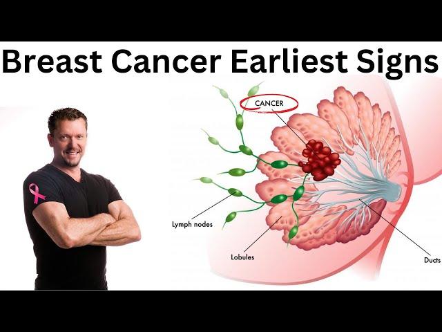 Earliest Signs of Breast Cancer [Doctor Explains] 2024