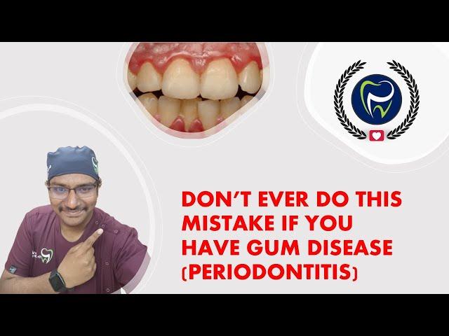 Dr Rudra Mohan |DONT EVER DO THIS MISTAKE IF YOU HAVE GUM DISEASE !| WATCH UNTIL THE END|BE CAREFUL!