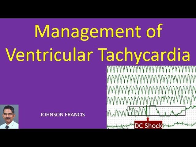 Management of Ventricular Tachycardia