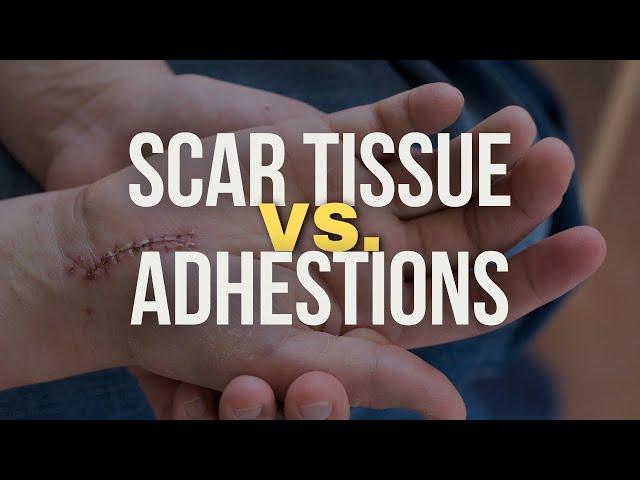 Scar Tissue vs. Adhesions: What’s the Difference?