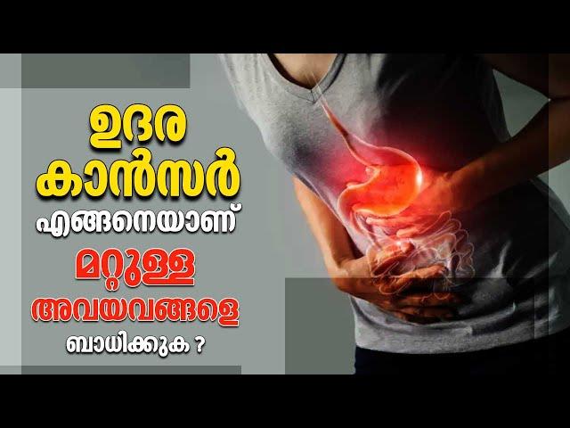 Stomach cancer | ഉദര കാൻസർ എങ്ങനെയാണ് മറ്റുള്ള അവയവങ്ങളെ ബാധിക്കുക ? | Arogya Kaumudy