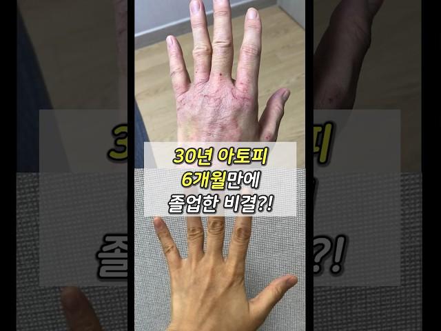 30년 아토피, ‘이걸’ 몰라서 헤맸던 거였어요ㅠㅠ