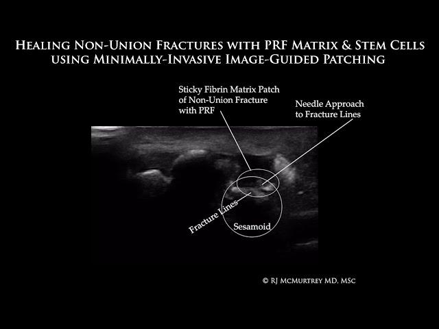 Healing Non-Union Sesamoid Fractures with PRF Fibrin Matrix (Platelet-Rich Fibrin) & Stem Cells