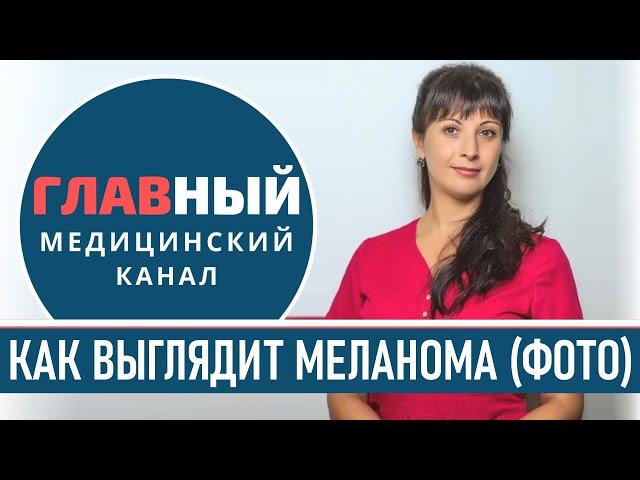 Как выглядит МЕЛАНОМА (фото 1-9). Симптомы и признаки меланомы. Как определить рак кожи