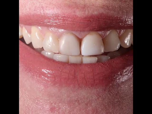 Veneers Composite Vs  Porcelain Veneers - Dr Walid Zalaket Beirut Lebanon