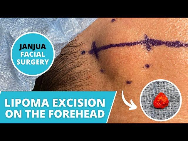 LIPOMA EXCISION ON THE FOREHEAD - DR. TANVEER JANJUA - NEW JERSEY