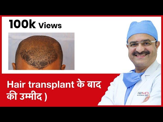 Hair Growth: What To Expect After Hair Transplant (Hair transplant के बाद की उम्मीद ) | (In HINDI)