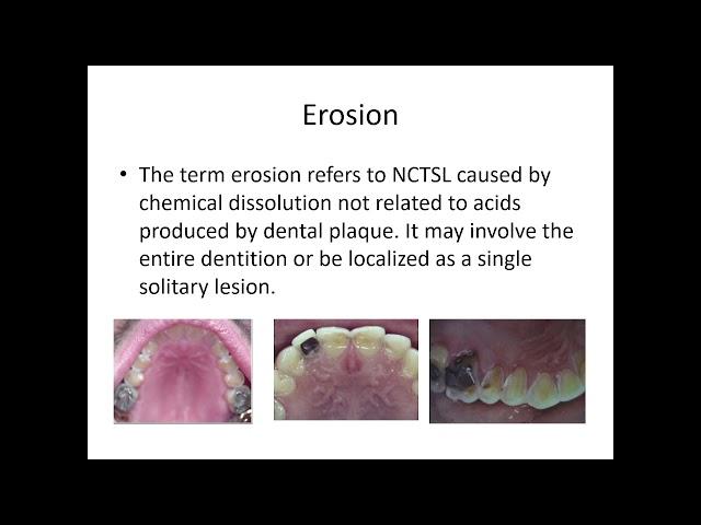 Tooth Wear Management. Prof Noor Adden Abo Arsheed