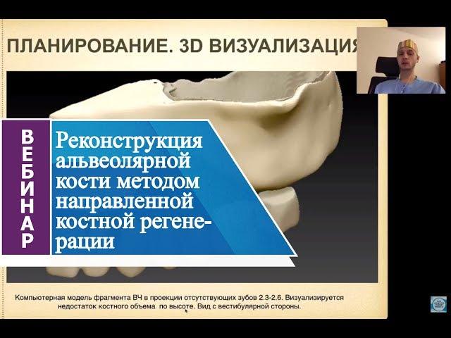 Реконструкция альвеолярной кости методом направленной костной регенерации