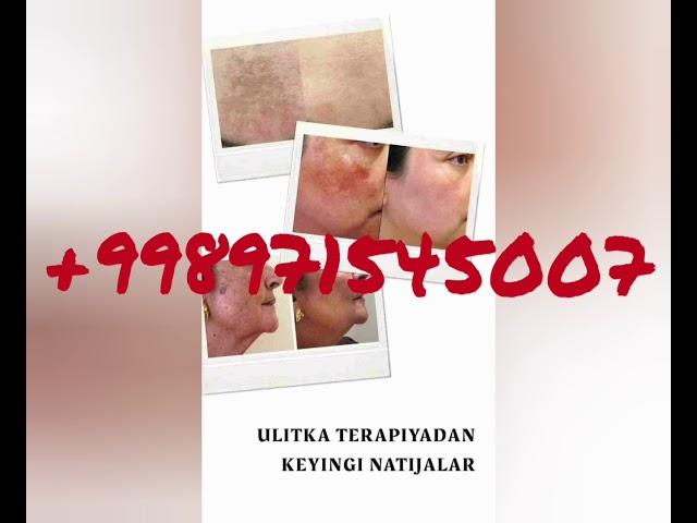 УЛИТКА ТЕРАПИЯ ТАБИЙ КАСМЕТИКА БИЗЛАРДА ХАММАСИ ТАБИЙ ВА ИШОНЧЛИ.