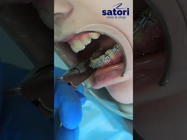 Coming soon on our channel is a long video about removing braces.