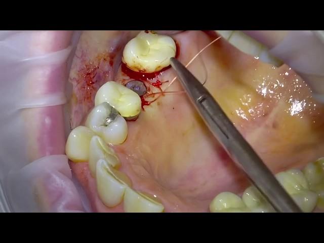 Placing a Straumann BLX Dental Implant