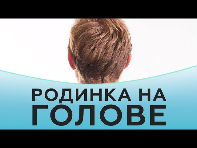 Удаление родинок на голове