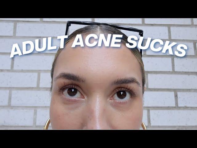 FINALLY clearing my adult acne! (my current skincare favs)