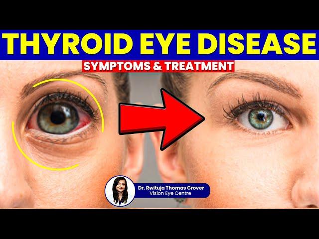 Thyroid Eye Disease: Symptoms & Treatment Explained