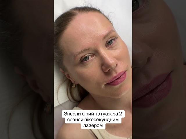 Видаляємо татуаж лазером #перманенткиїв