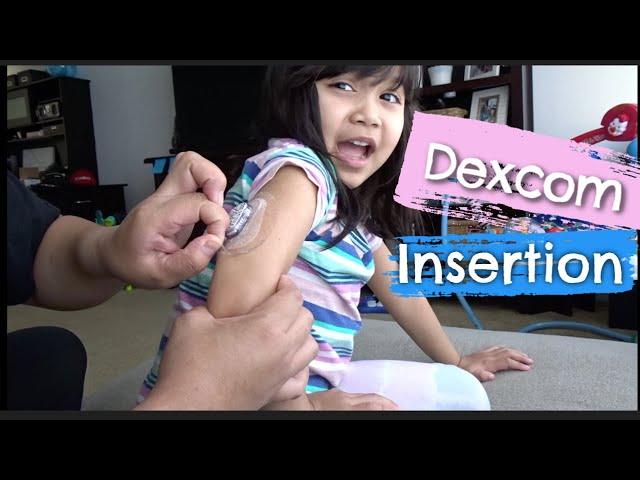 Step By Step Dexcom CGM Insertion | The Dose Family