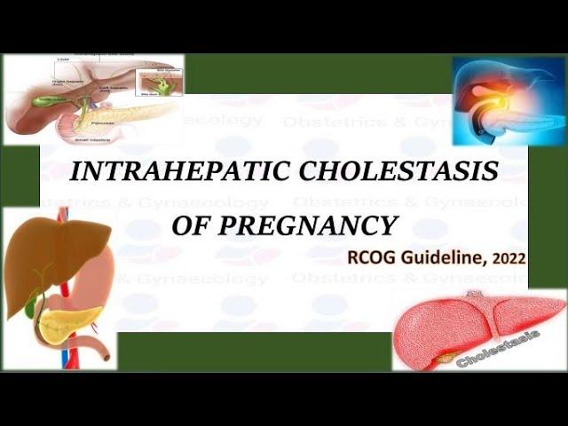 Intrahepatic Cholestasis of Pregnancy , RCOG Guideline (2022)