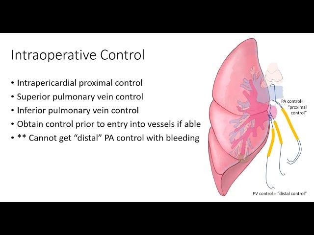 PA Control During Lung Surgery