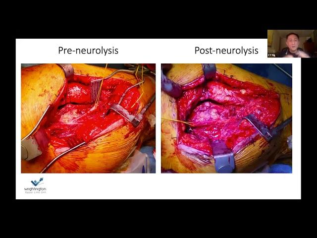 Nerve palsy following surgery? What are the possible causes! CY Ng nerve surgeon explains