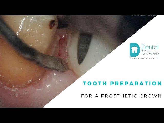 Tooth preparation for a prosthetic crown