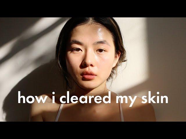 HOW I GOT RID OF ACNE, TEXTURED SKIN unsponsored skincare routine + diet