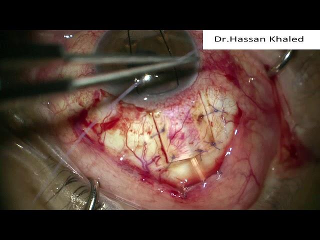 Ahmed Valve Implant For Neovascular Glaucoma Patient