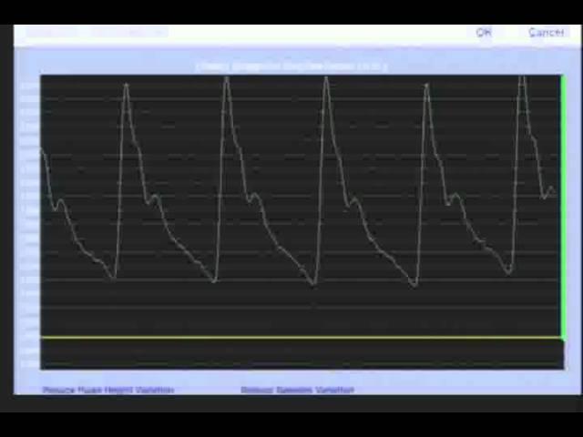 Pulse Wave Analysis