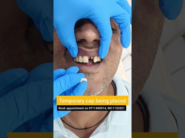 Temporary Cap over Front Dental Implant? Try Maryland Bridge! Dr. Srishti Bhatia #teeth #dental