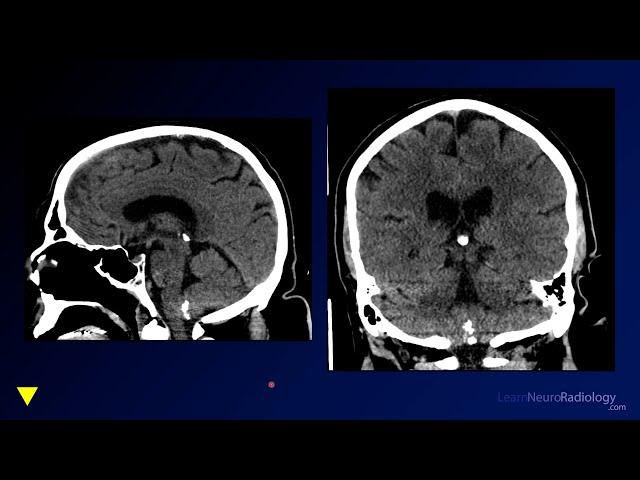 Neuroradiology Board Review - Brain Tumors - Case 15