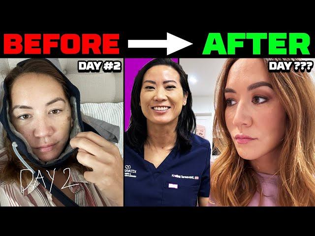 Facelift Recovery - What to Expect (BEFORE AFTER RESULTS)