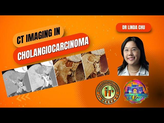 Linda Chu | Cholangiocarcinoma