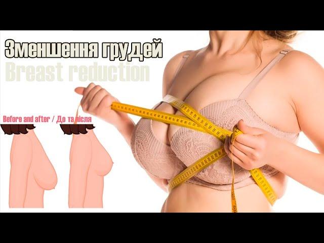 Breast reduction / Зменшення та підтяжка грудей в Україні