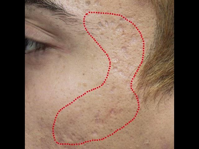 Acne Scar Treatment